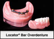 Locator Bar Denture