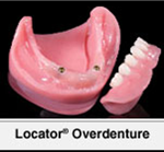Locator Implant denture
